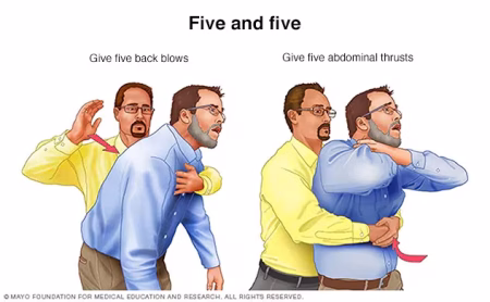 Five Mistakes People Make When a Choking Adult Collapses